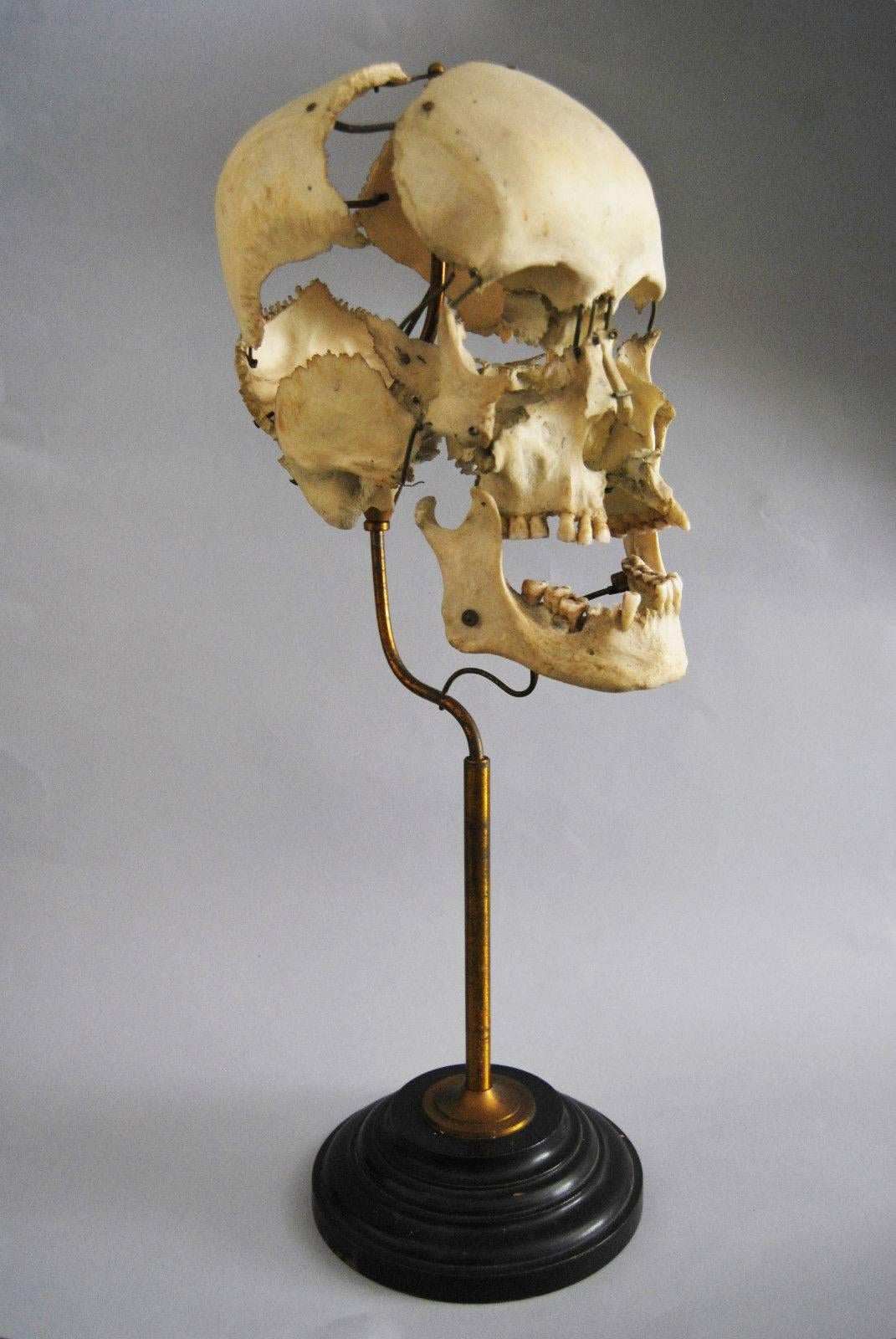 A Beauchene Skull, also known as an exploded skull, is a disarticulated human skull that has been painstakingly reassembled on a stand with jointed, movable supports that allows for the moving and studying of the skull as a whole or each piece