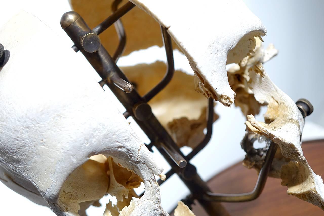 A Beauchene skull, also known as an exploded skull, is a disarticulated human skull that has been painstakingly reassembled on a Stand with jointed, movable supports that allows for the moving and studying of the skull as a whole or each piece