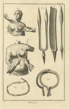 Breast Operation and Ring Clamp, Diderot Chirurgie Plate XXIX, circa 1772