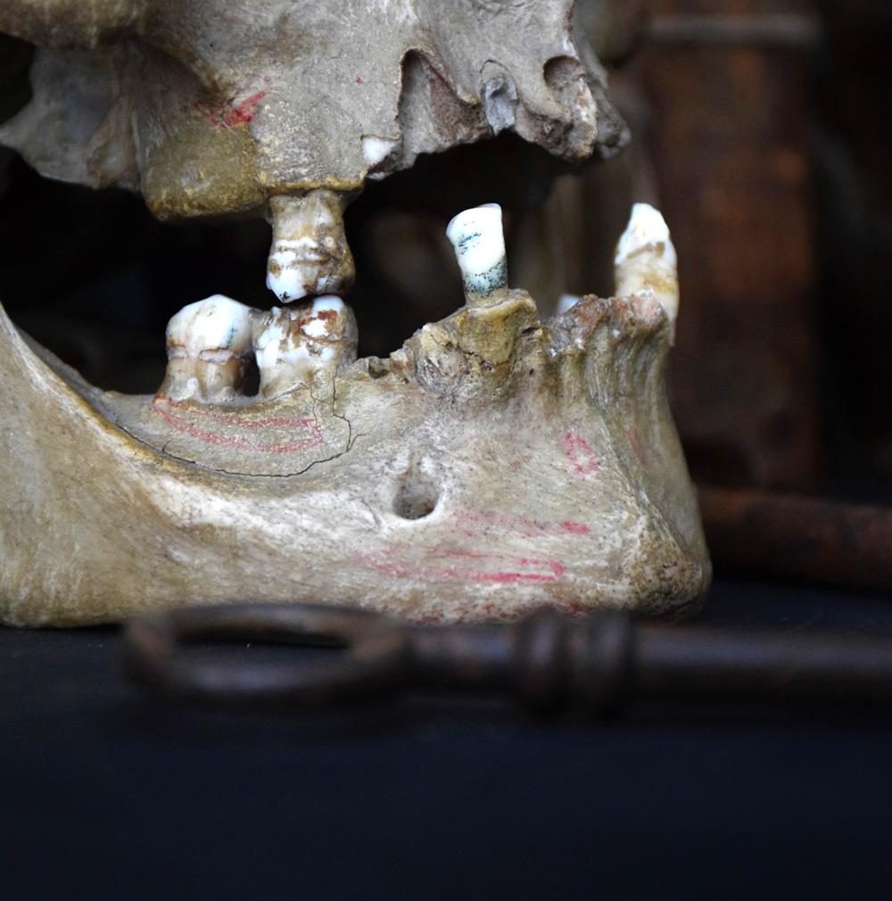 Early 20th Century Deformed Human Skull 0.3