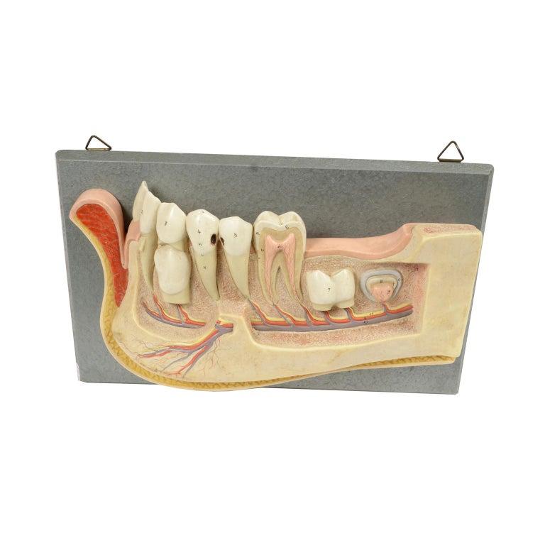 Didactic anatomical model of an enlarged jaw, mounted on a wooden board with hooks for hanging. In evidence the circulatory system, the roots of the teeth, and two caries. Made in hand-colored resin in Western Germany in the 1950s. Very good