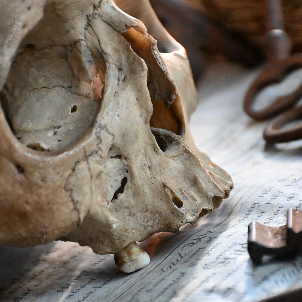 Échantillon de crâne humain chirurgical du début du 19e siècle, dans le domaine de la médecine et de la science 

Exemple d'un spécimen de crâne humain chirurgical de la science médicale du 19e siècle. Ce spécimen n'est constitué que de la partie