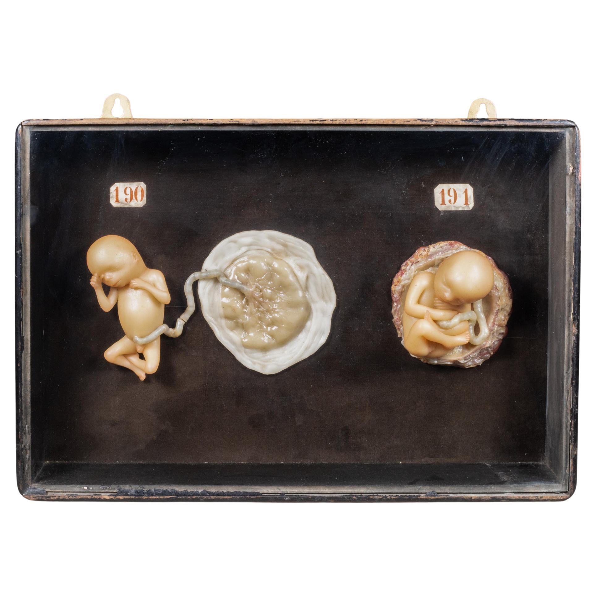 Early 19th c.Medical Teaching Device- Shadowboxed Wax Fetus Models c.1800-1850