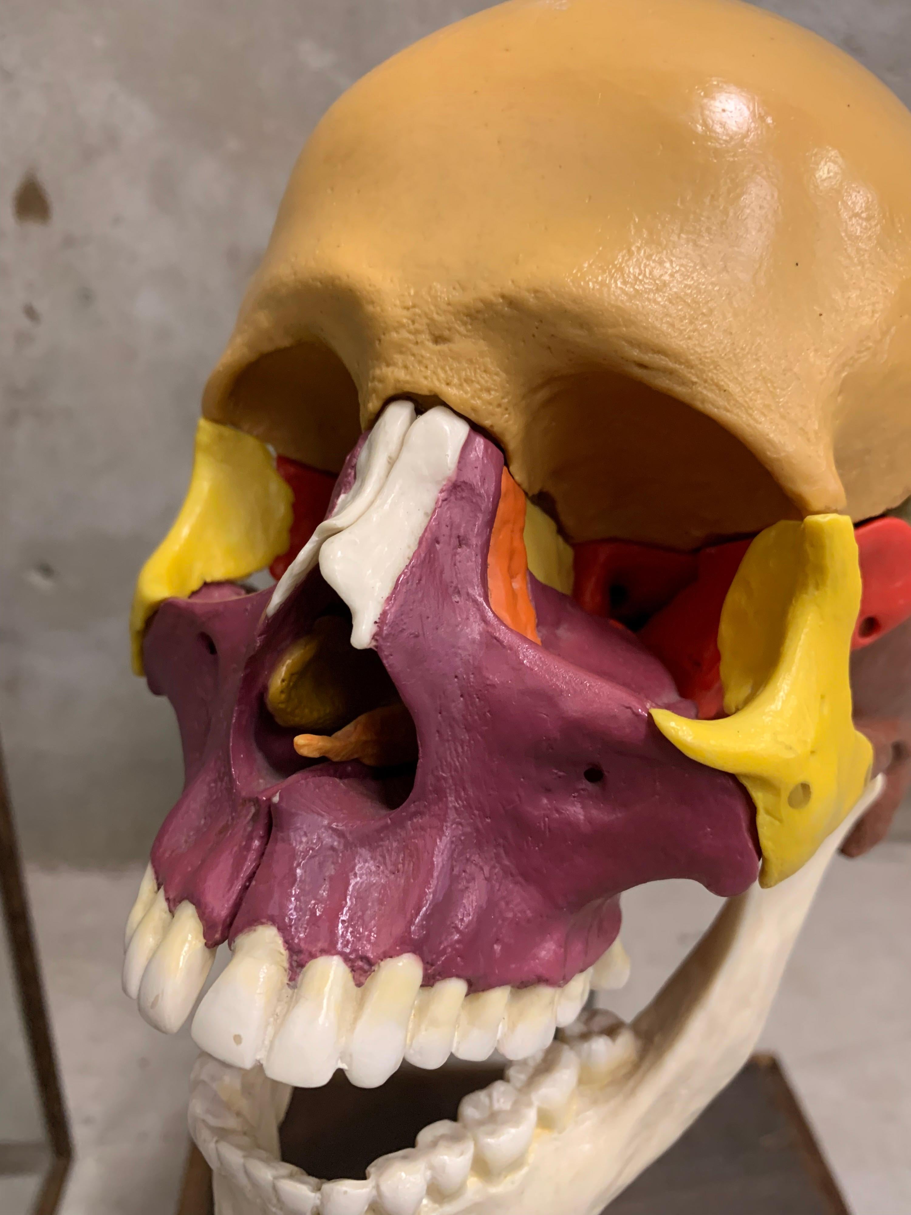 Full-Size Somso Skull Learning Model in Display Case, 1990's In Good Condition In Hoogeveen, NL
