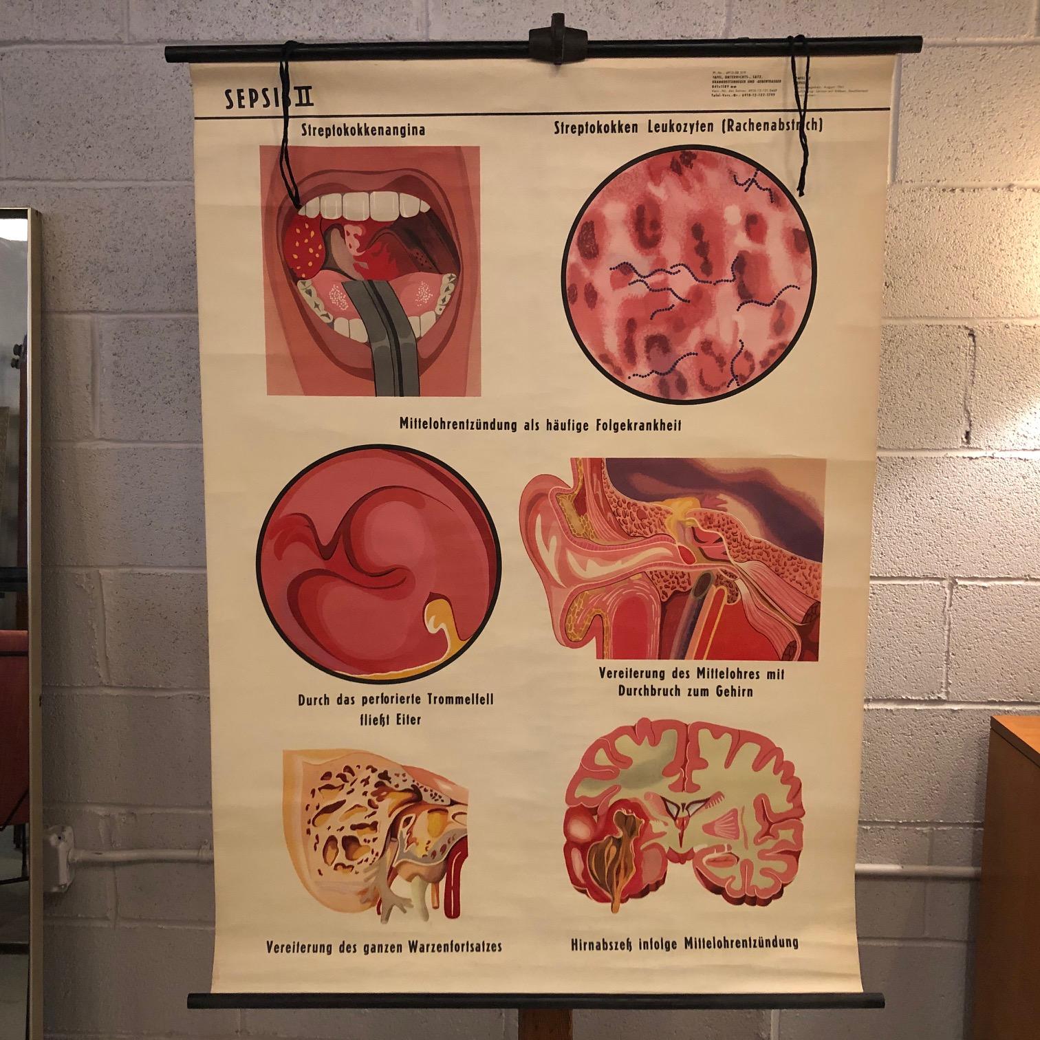 German, educational, anatomical, roll-up, chart Sepsis II Medical Study chart the depicting the stages of the bacterial infection is printed on canvas backed paper with maple rods with ring for hanging.