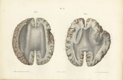 Horizontal Sections of the Cerebrum, Antique Hirschfeld Anatomy Print, 1866
