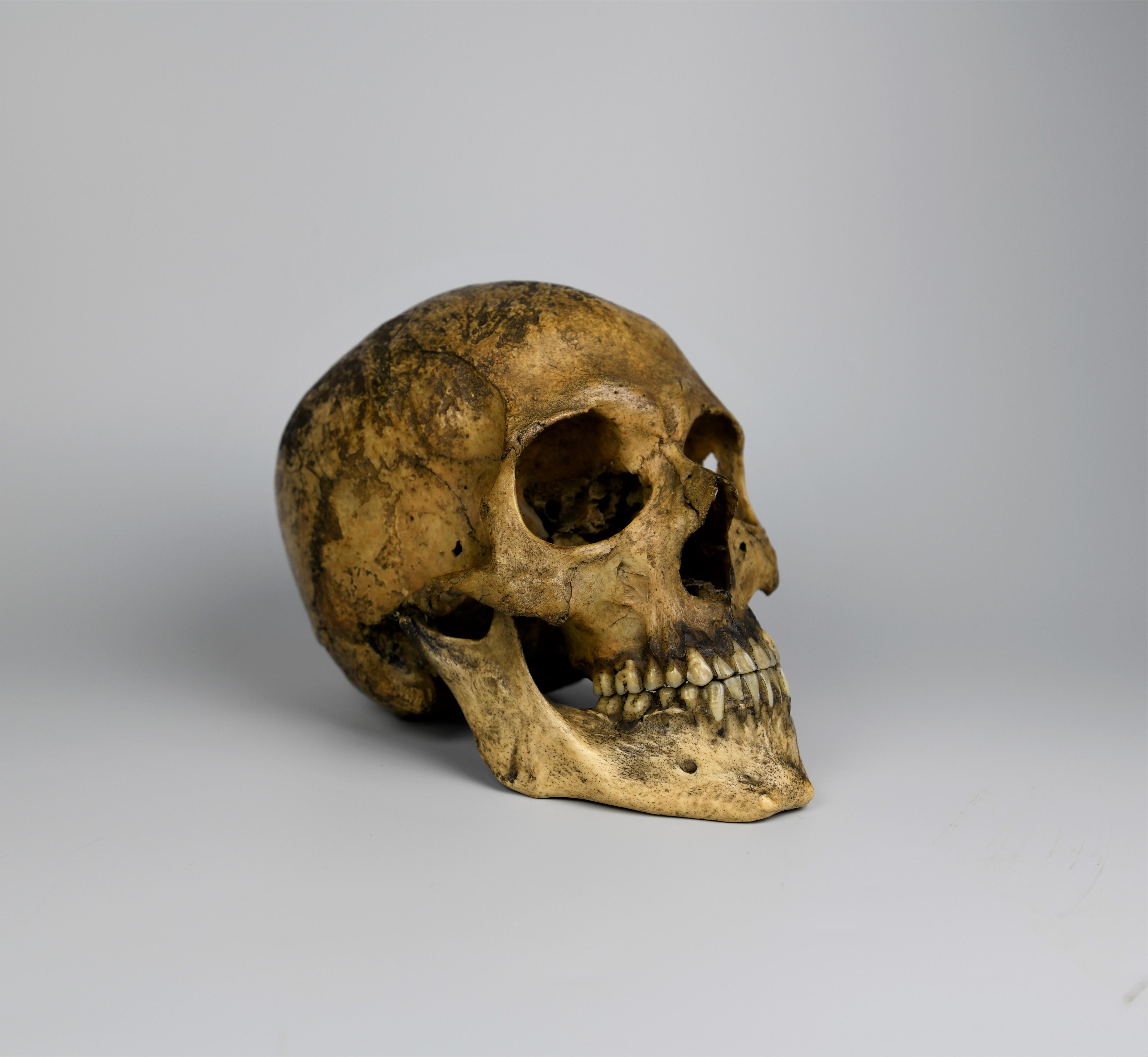 Superior example of a human (Medical) skull, 19th century. This skull was for medical use and display purposes. On back of the skull is a hole to keep secure when fixed it's got a wonderful patina and the teeth look to have been reset in keeping