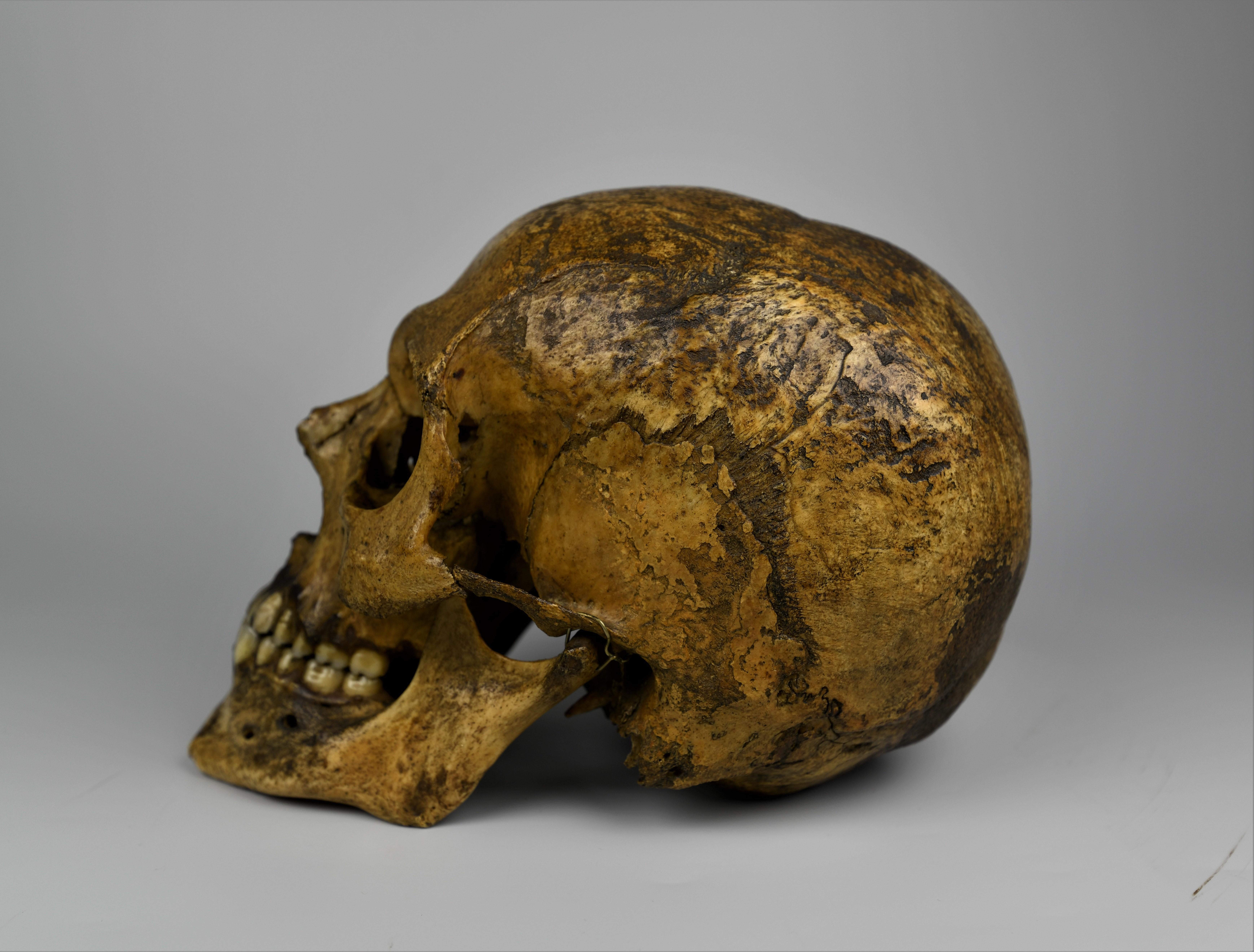 Early Victorian Human Medical Skull 19th Century Mesopotamian