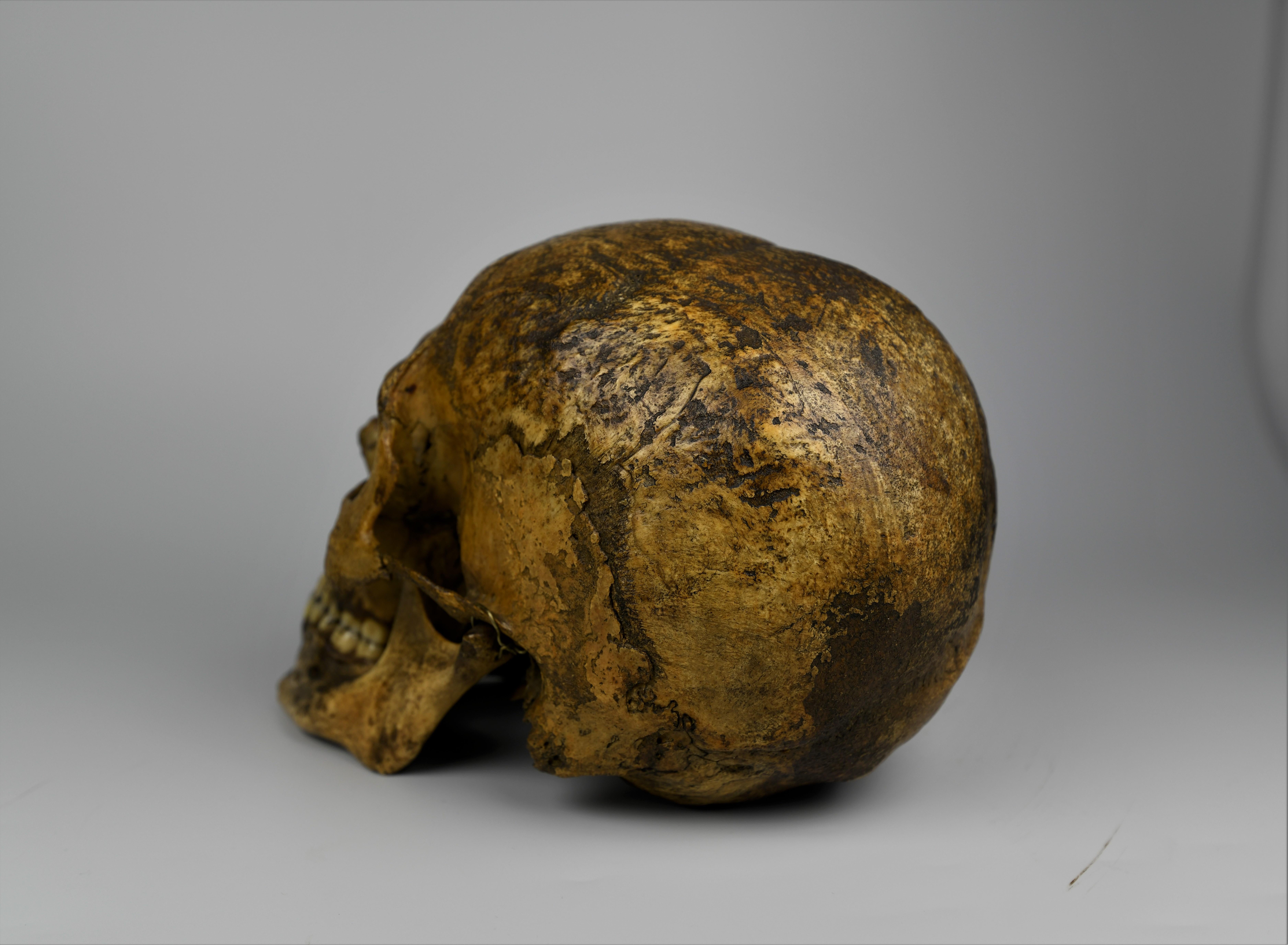 Mid-19th Century Human Medical Skull 19th Century Mesopotamian