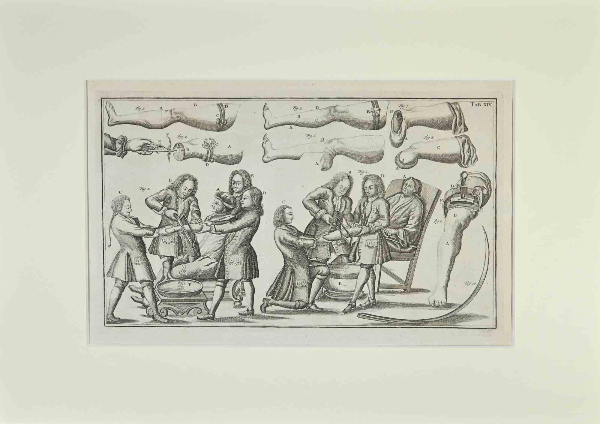 Surgical Treatments is part of the suite realized by Lorenz Heister in the series of Institutiones Chirurgicae, Amsterdam, Janssonius-Waesberg, 1750.

Etching on paper.

The work belongs to the Latin edition of the famous work by the founder of