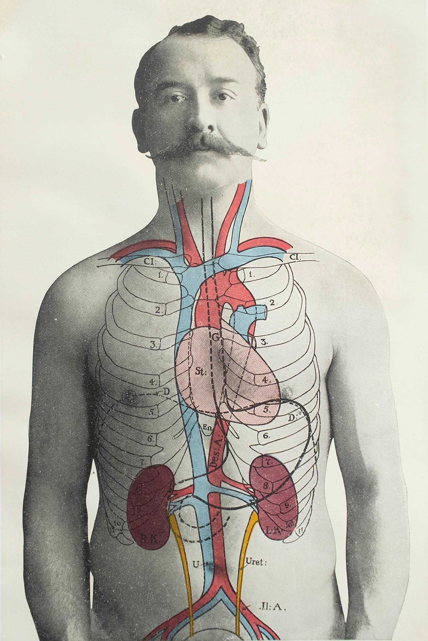 Great image of medical interest.

Unframed.

Published, circa 1900.





