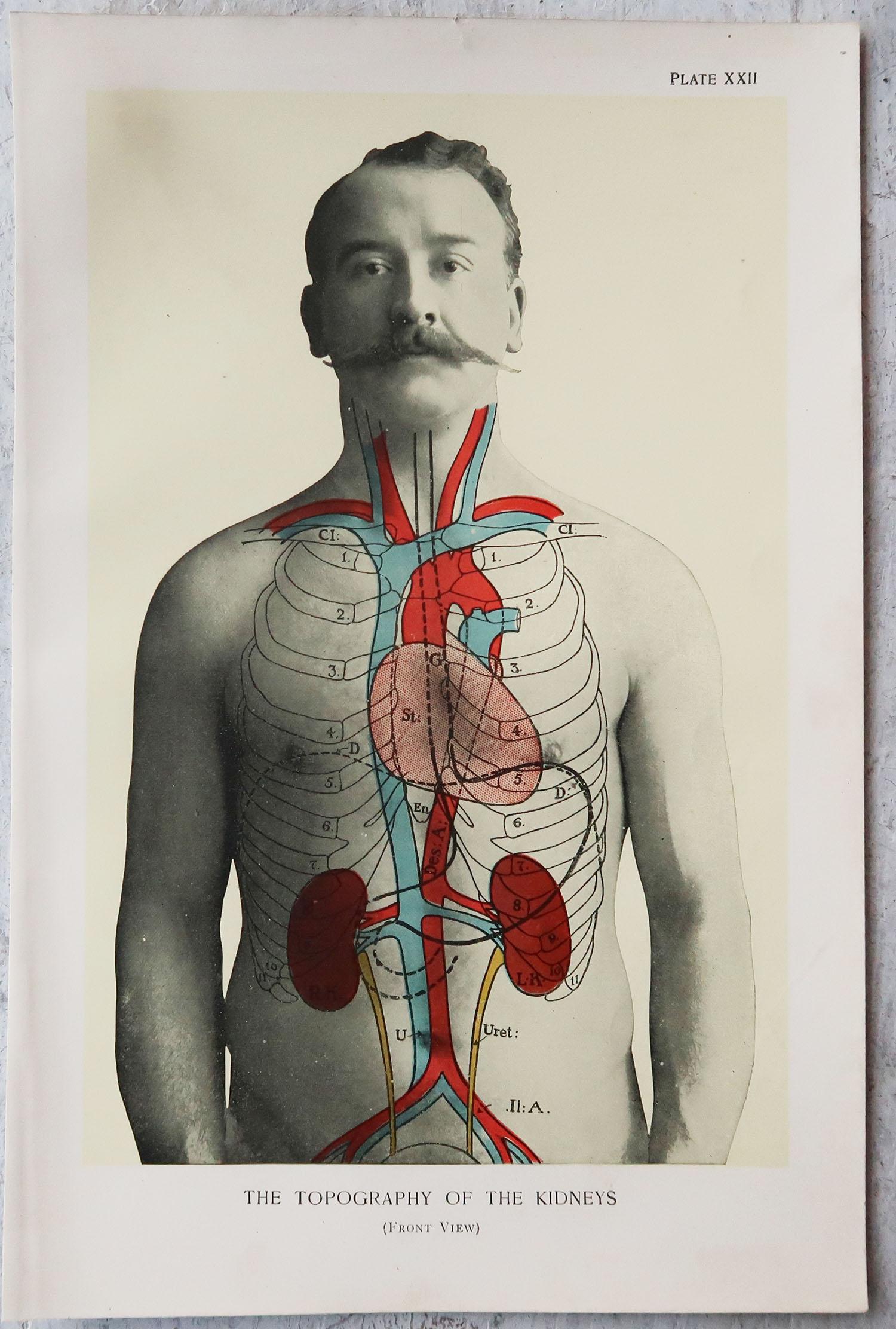 English Original Vintage Medical Print- Kidneys, C.1900