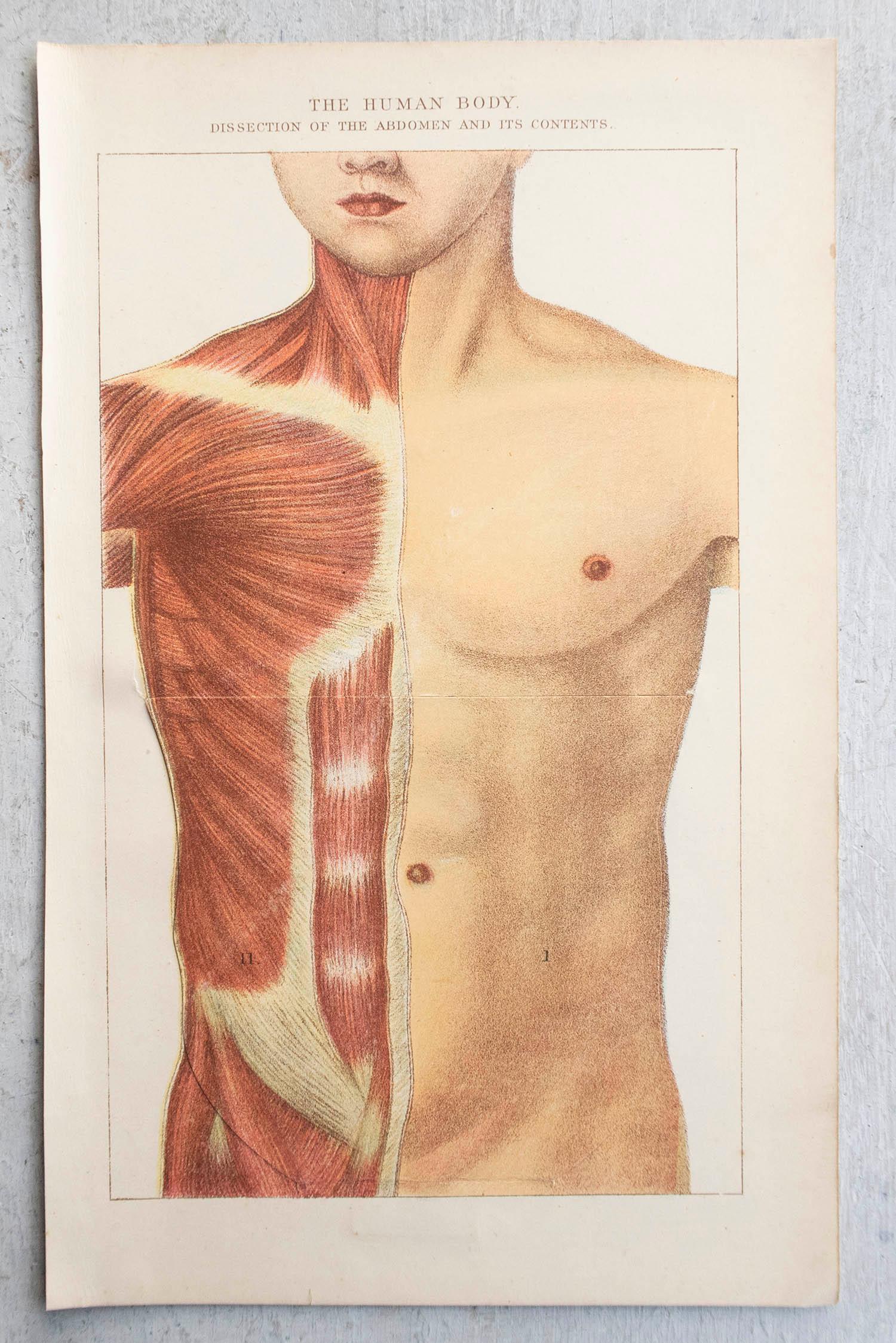 Édouardien Impression médicale originale de l'Abdomen, vers 1900 en vente