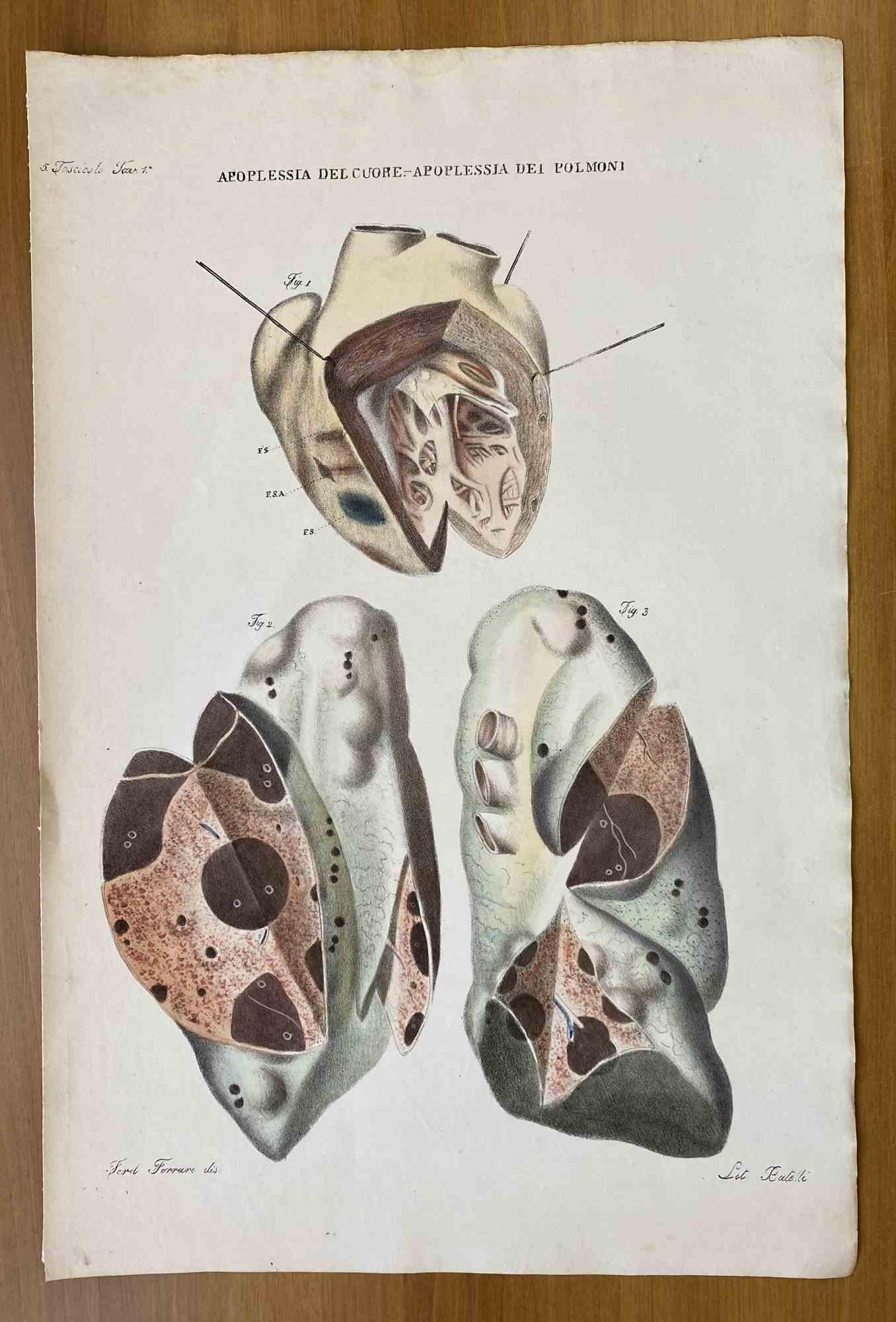 Apoplexy of the Heart and Lungs is a lithograph hand colored by Ottavio Muzzi for the edition of Antoine Chazal, Human Anatomy, Printers Batelli and Ridolfi, 1843.

The work belongs to the Atlante generale della anatomia patologica del corpo umano