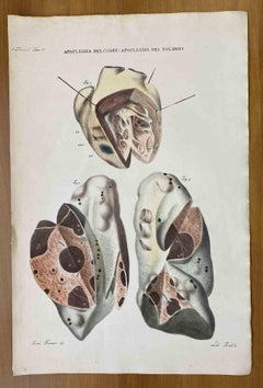 Antique Apoplexy of the Heart and Lungs - Lithograph By Ottavio Muzzi - 1843