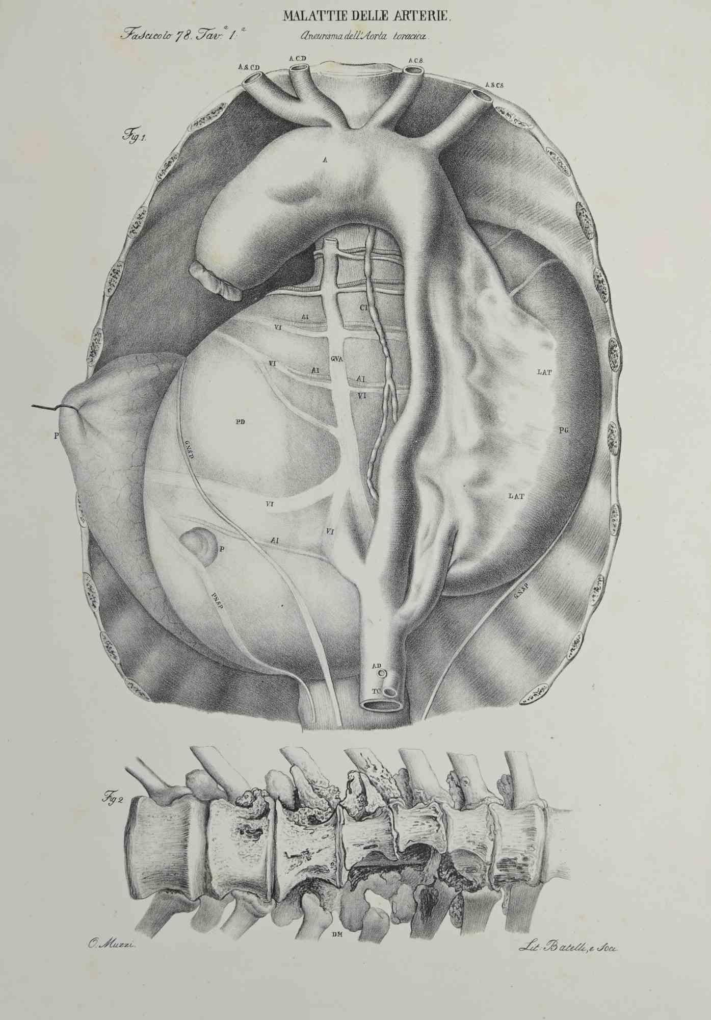 Artery Disease is a lithograph realized by Ottavio Muzzi for the edition of Antoine Chazal, Human Deseases, Printers Batelli and Ridolfi, 1843.

The work belongs to the Atlante generale della anatomia patologica del corpo umano by Jean CRUVEILHIER,