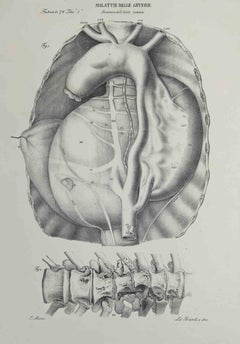 Artery Disease - Lithograph By Ottavio Muzzi - 1843