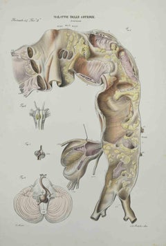 Artery Disease - Lithograph By Ottavio Muzzi - 1843