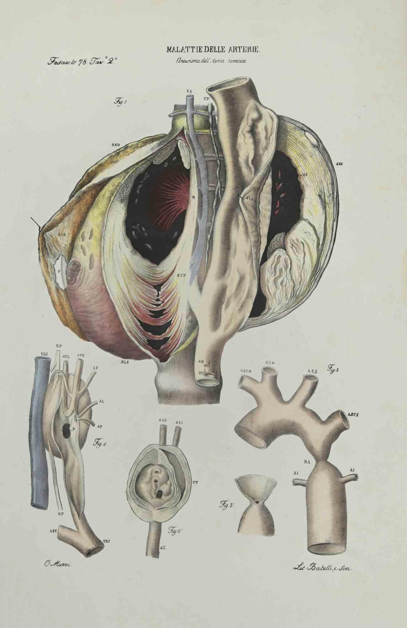 Artery Disease ist eine handkolorierte Lithographie von Ottavio Muzzi für die Ausgabe von Antoine Chazal, Human Deseases, Printers Batelli and Ridolfi, 1843.

Das Werk gehört zum Atlante generale della anatomia patologica del corpo umano von Jean
