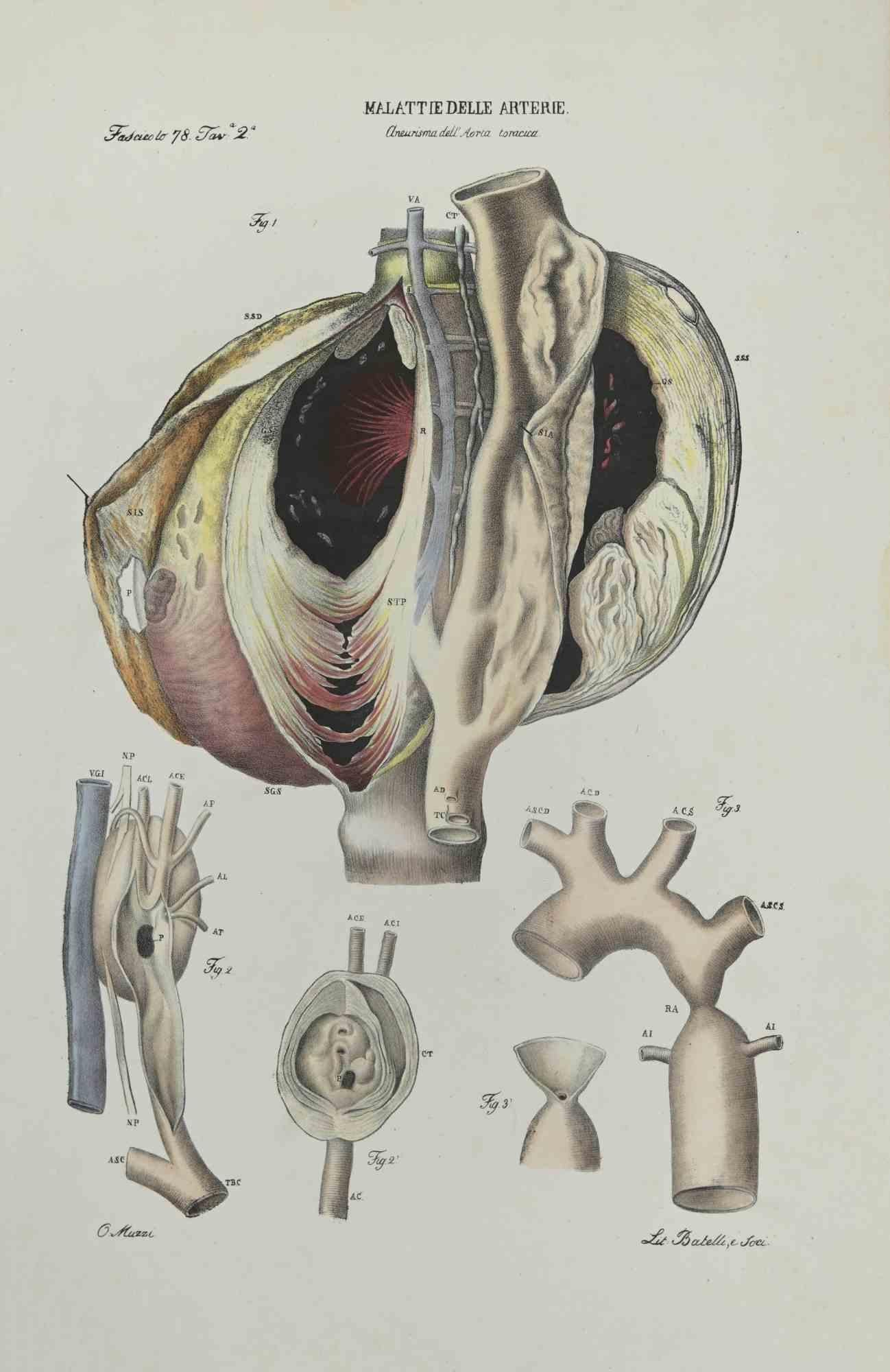 Artery Disease is a lithograph hand colored by Ottavio Muzzi for the edition of Antoine Chazal, Human Deseases, Printers Batelli and Ridolfi, 1843.

The work belongs to the Atlante generale della anatomia patologica del corpo umano by Jean