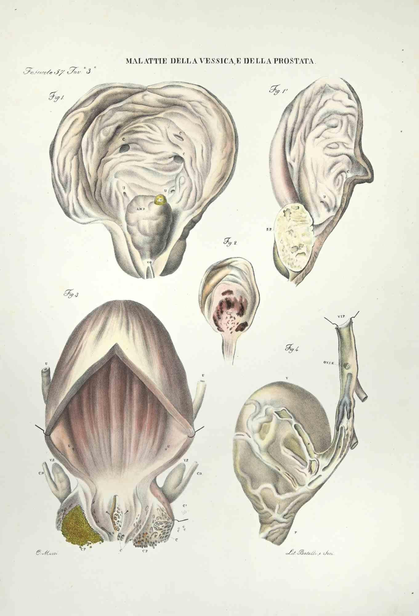 Bladder and Prostate Diseases is a lithograph hand colored by Ottavio Muzzi for the edition of Antoine Chazal,Human Anatomy, Printers Batelli and Ridolfi, realized in 1843.

Signed on plate on the lower left margin.

The artwork belongs to the