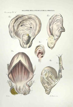 Bladder- und Prostate-Krankheiten – Lithographie von Ottavio Muzzi – 1843