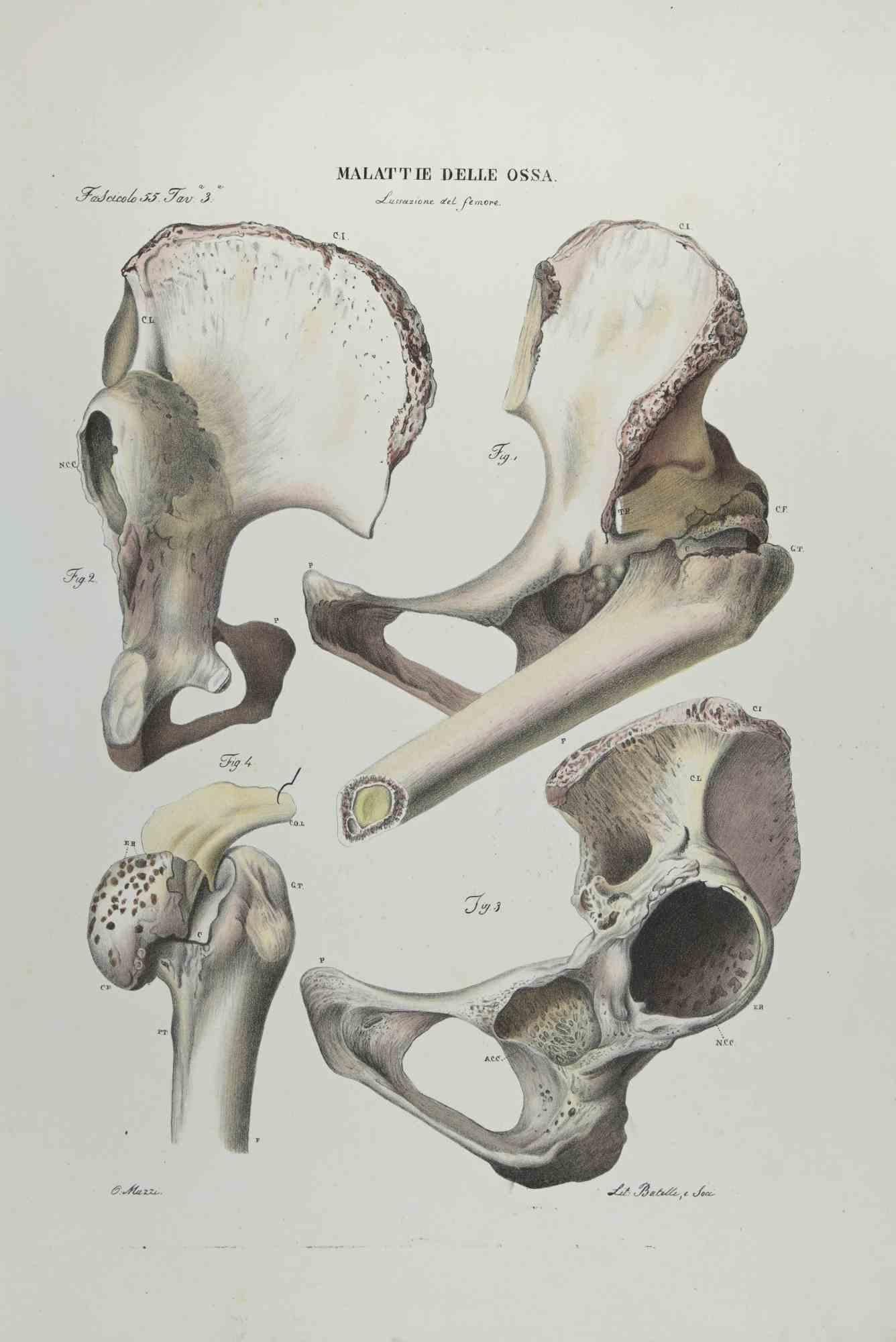 Bone Disease is a lithograph hand colored by Ottavio Muzzi for the edition of Antoine Chazal, Human Anatomy, Printers Batelli and Ridolfi, 1843.

The work belongs to the Atlante generale della anatomia patologica del corpo umano by Jean CRUVEILHIER,