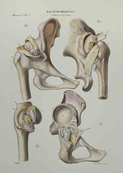 Enfermedad ósea - Litografía de Ottavio Muzzi - 1843
