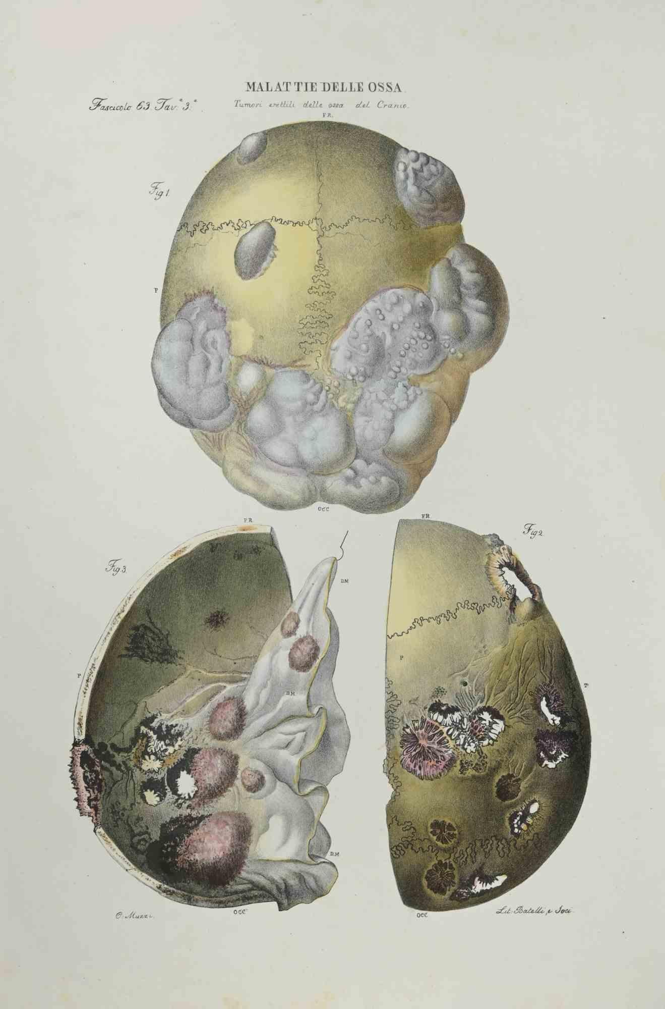 Bone Disease is a lithograph hand colored by Ottavio Muzzi for the edition of Antoine Chazal, Human Anatomy, Printers Batelli and Ridolfi, 1843.

The work belongs to the Atlante generale della anatomia patologica del corpo umano by Jean CRUVEILHIER,