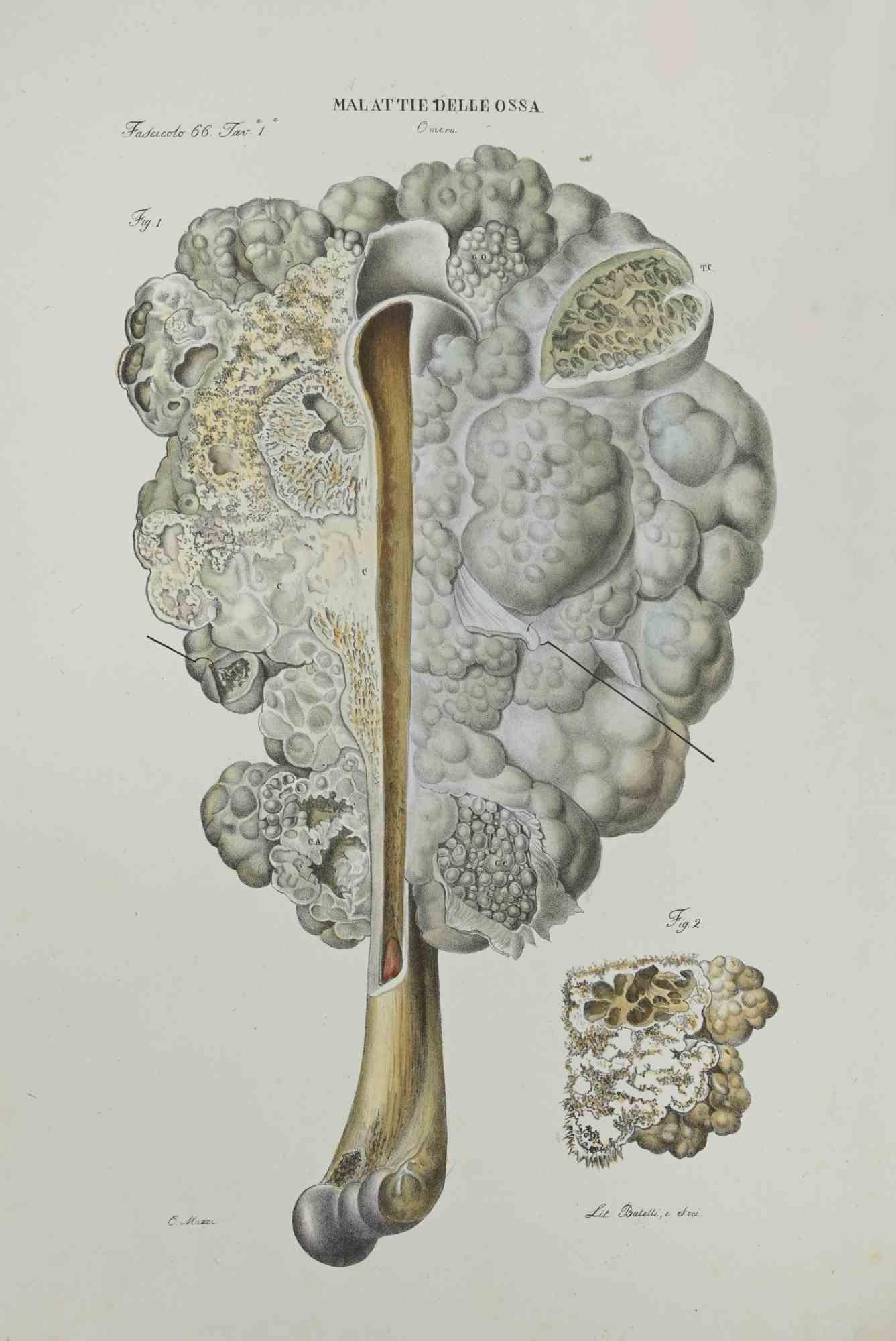 Bone Disease is a lithograph hand colored by Ottavio Muzzi for the edition of Antoine Chazal, Human Anatomy, Printers Batelli and Ridolfi, 1843.

The work belongs to the Atlante generale della anatomia patologica del corpo umano by Jean CRUVEILHIER,