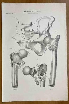 Knochenkrankheiten – Lithographie von Ottavio Muzzi – 1843