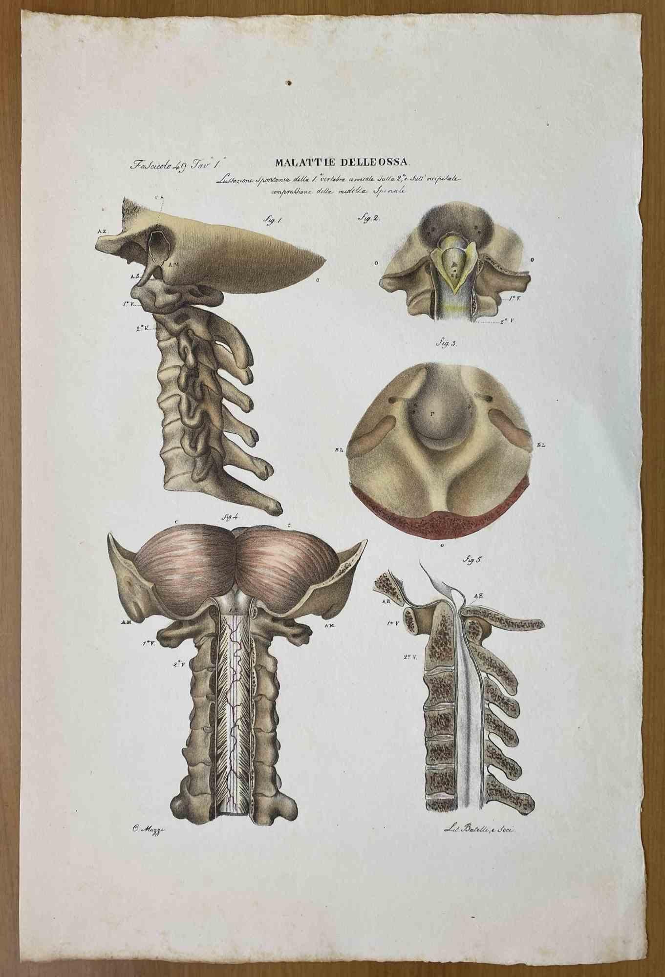 Brain Disease is a lithograph hand colored by Ottavio Muzzi for the edition of Antoine Chazal, Human Anatomy, Printers Batelli and Ridolfi, 1843.

The work belongs to the Atlante generale della anatomia patologica del corpo umano by Jean