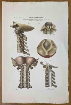 Antique Bone Diseases - Lithograph By Ottavio Muzzi - 1843