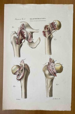 Antique Bone Diseases - Lithograph By Ottavio Muzzi - 1843