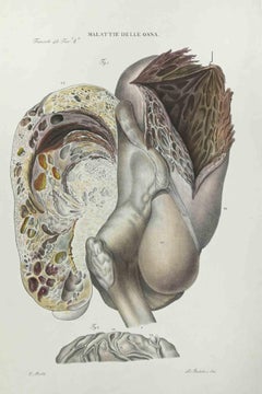 Lithographie sur les maladies de l'os par Ottavio Muzzi - 1843