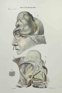 Knochenkrankheiten – Lithographie von Ottavio Muzzi – 1843