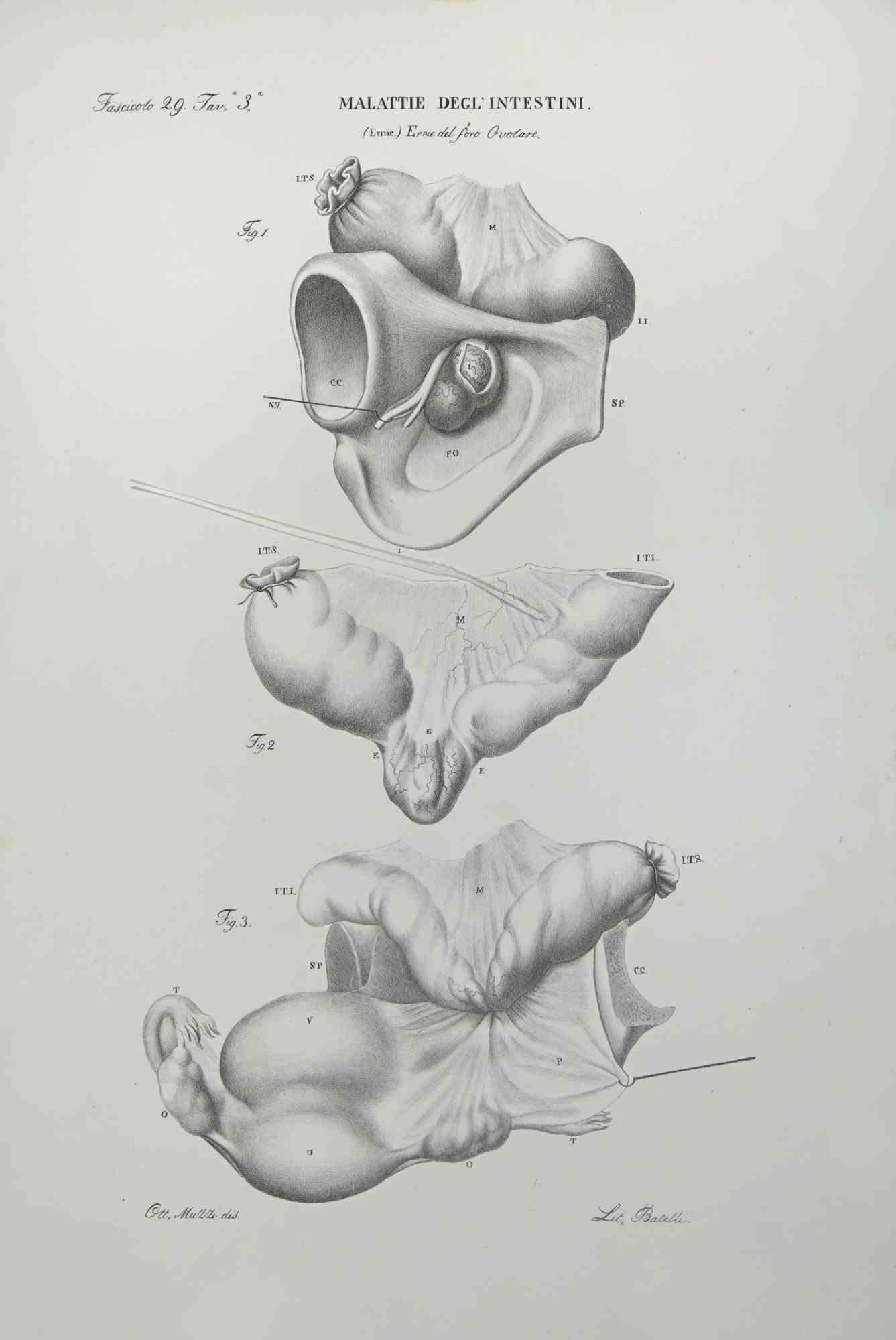 Darmerkrankungen ist eine Lithographie von Ottavio Muzzi für die Ausgabe von Antoine Chazal, Human Anatomy, Druckerei Batelli und Ridolfi, 1843.

Das Werk gehört zum Atlante generale della anatomia patologica del corpo umano von Jean CRUVEILHIER,