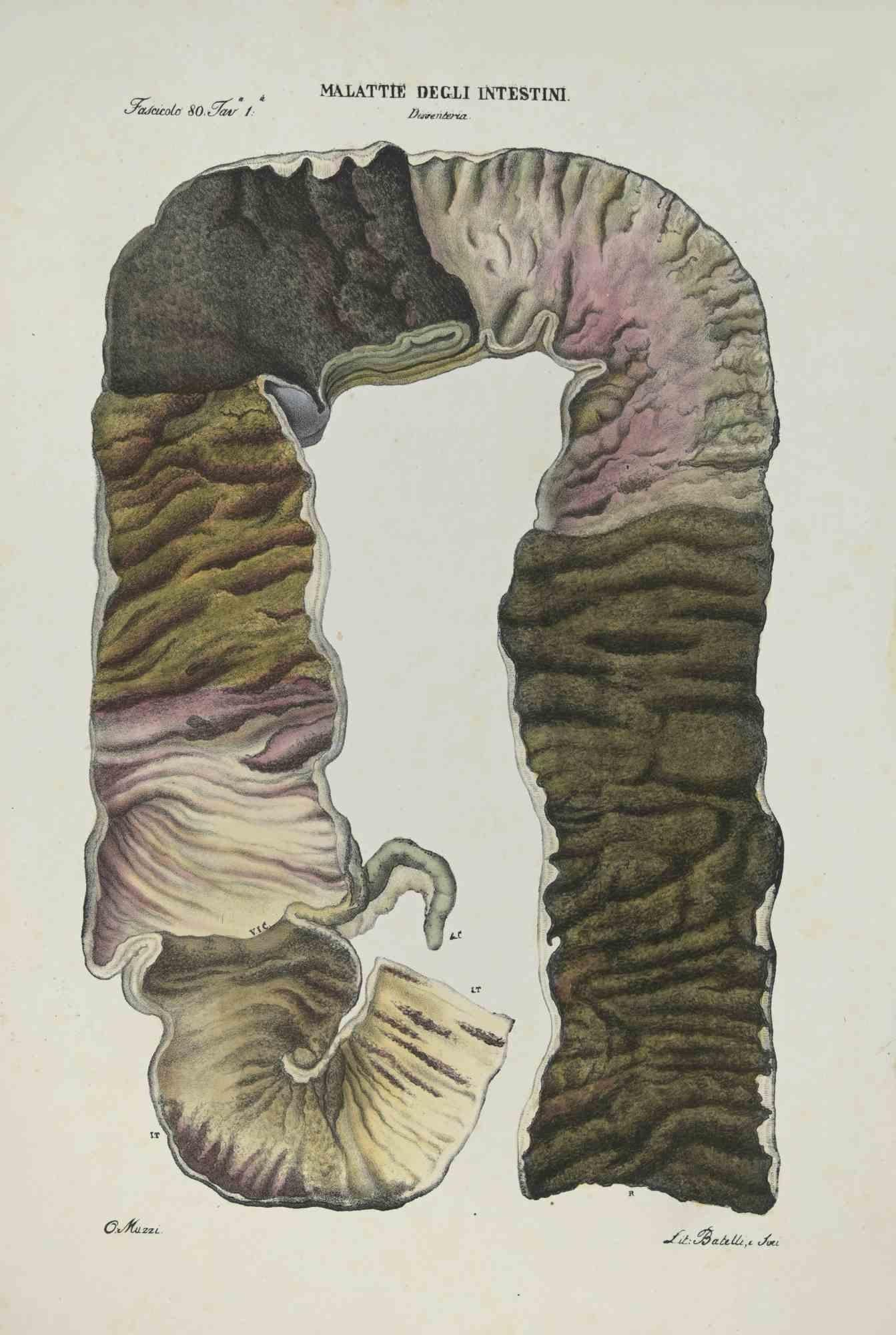 Malattie dell'intestino - Litografia di Ottavio Muzzi - 1843