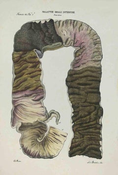 Bowel Diseases - Lithograph By Ottavio Muzzi - 1843