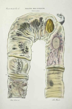 Intestino  Malattie - Litografia di Ottavio Muzzi - 1843
