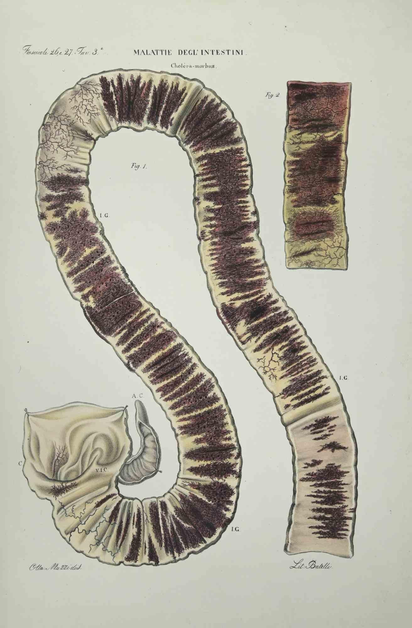Enfermedades intestinales es una litografía coloreada a mano por Ottavio Muzzi para la edición de Antoine Chazal, Anatomía humana, Imprenta Batelli y Ridolfi, realizada en 1843.
Firmado en la plancha, en el margen inferior izquierdo. 

La obra