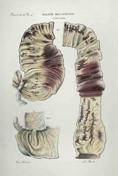 Bowel Diseases - Lithograph By Ottavio Muzzi - 1843