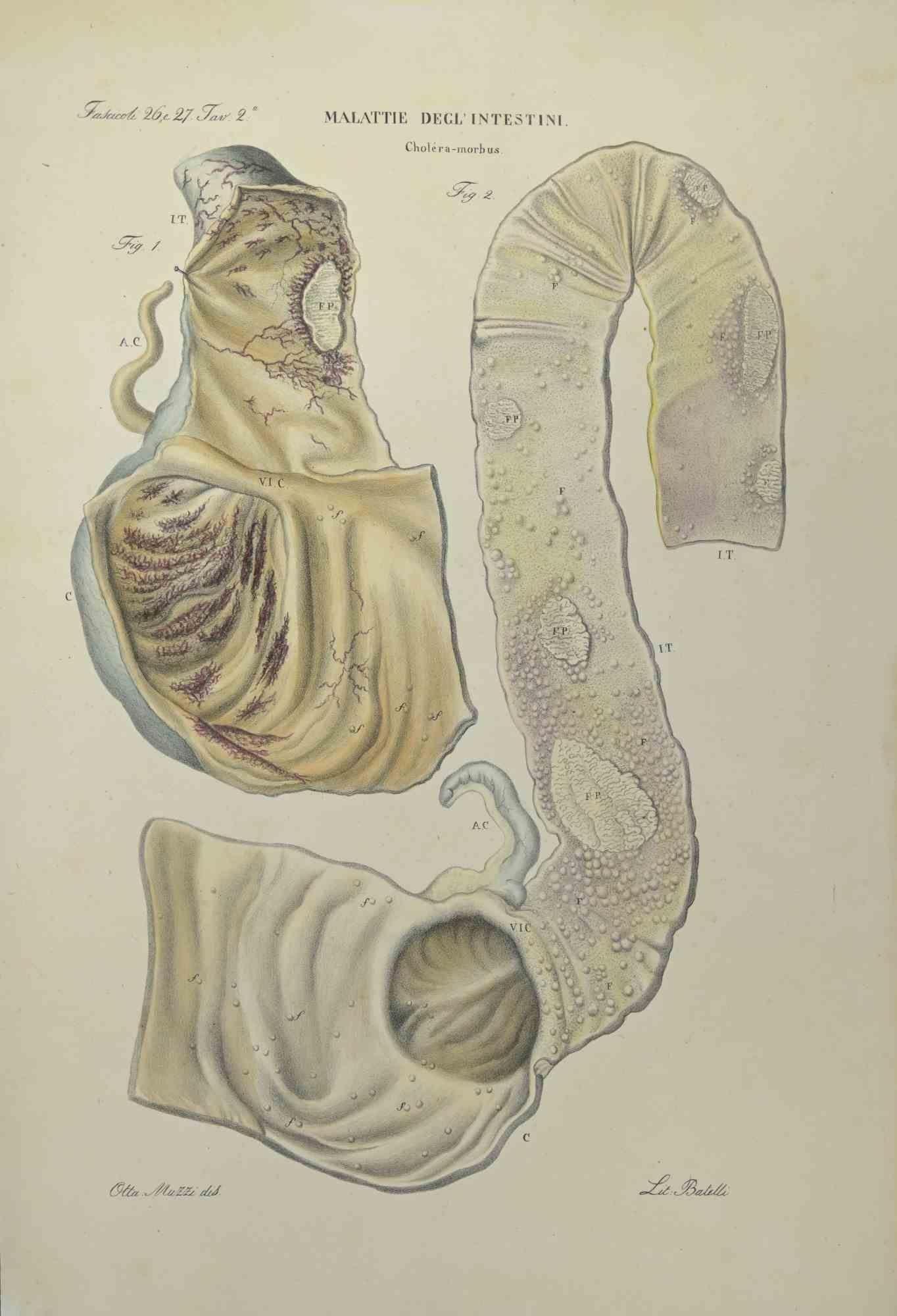 Malattie dell'intestino è una litografia colorata a mano da Ottavio Muzzi per l'edizione di Antoine Chazal, Anatomia umana, tipografia Batelli e Ridolfi, realizzata nel 1843.
Firmato sulla lastra nel margine inferiore sinistro. 

L'opera appartiene
