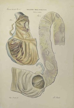 Bowel Diseases - Lithograph By Ottavio Muzzi - 1843