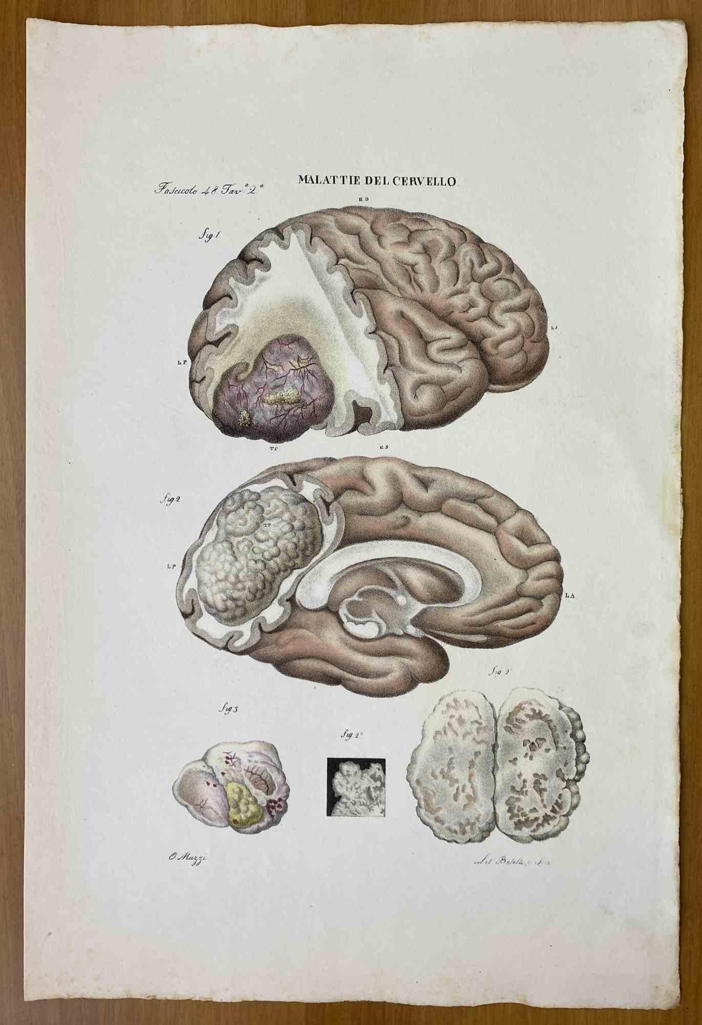 Brain disease – Lithographie von Ottavio Muzzi – 1843