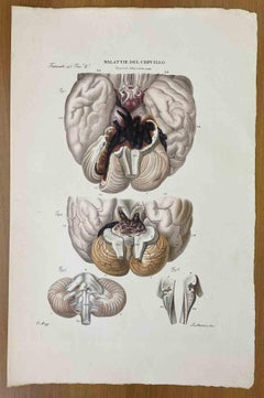 Antique Brain Diseases - Lithograph By Ottavio Muzzi - 1843