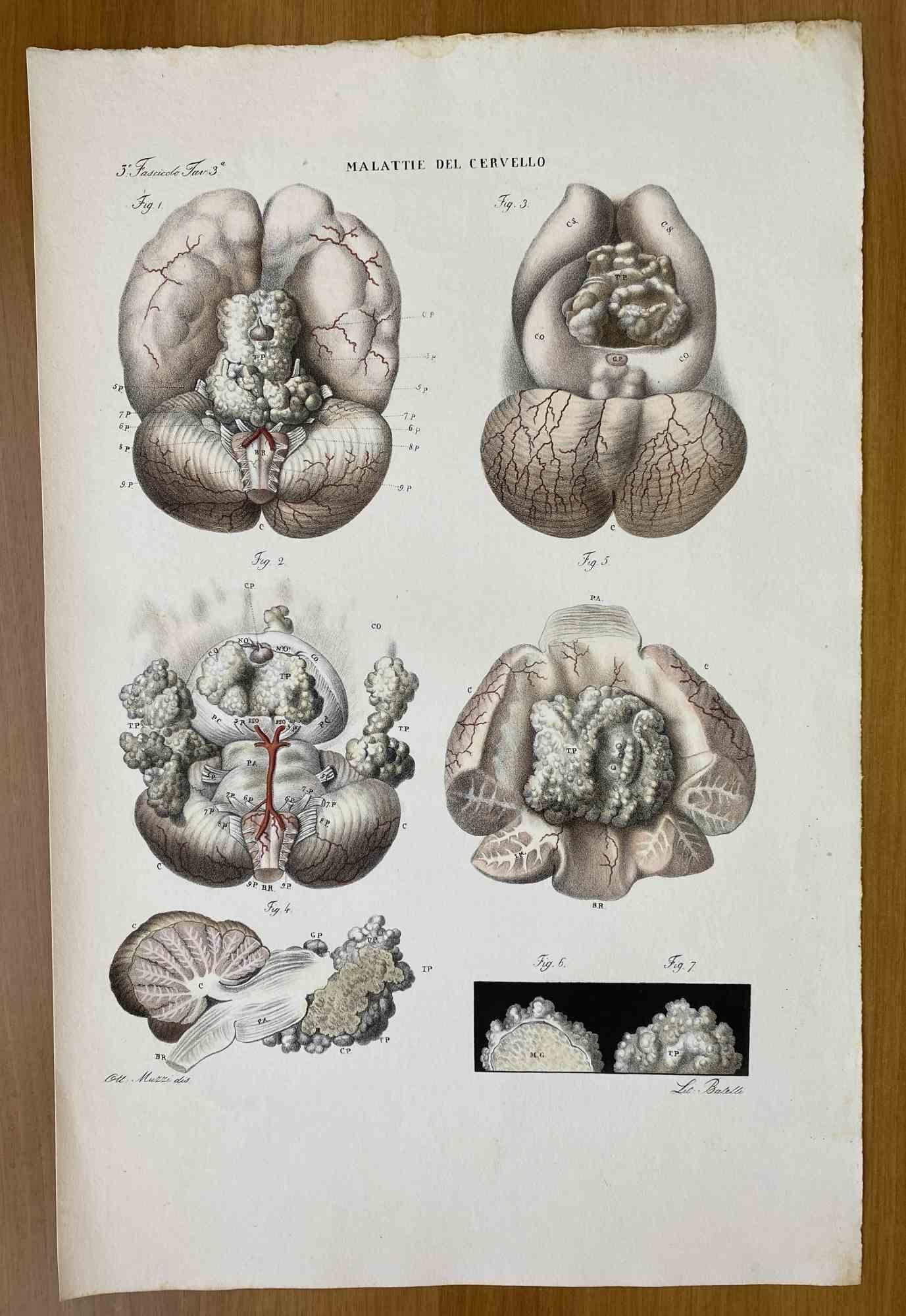 Brain Diseases is a lithograph hand colored by Ottavio Muzzi for the edition of Antoine Chazal, Human Anatomy, Printers Batelli and Ridolfi, 1843.

The work belongs to the Atlante generale della anatomia patologica del corpo umano by Jean