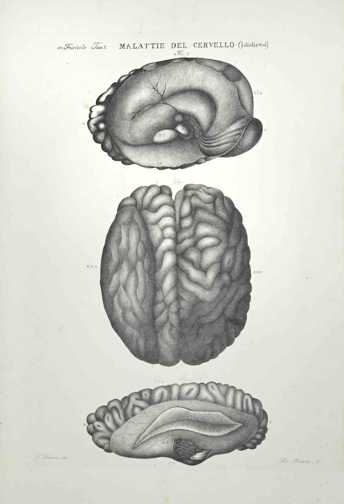 Brain Diseases is a lithograph hand colored by Ottavio Muzzi for the edition of Antoine Chazal, Human Anatomy, Printers Batelli and Ridolfi, 1843.

The work belongs to the Atlante generale della anatomia patologica del corpo umano by Jean