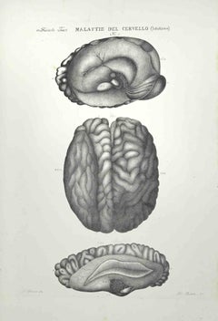 Malattie del cervello - Litografia di Ottavio Muzzi - 1843