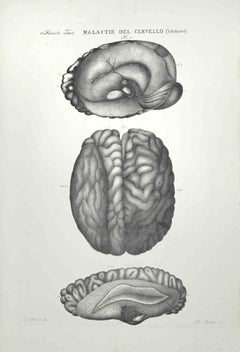 Antique Brain Diseases - Lithograph By Ottavio Muzzi - 1843